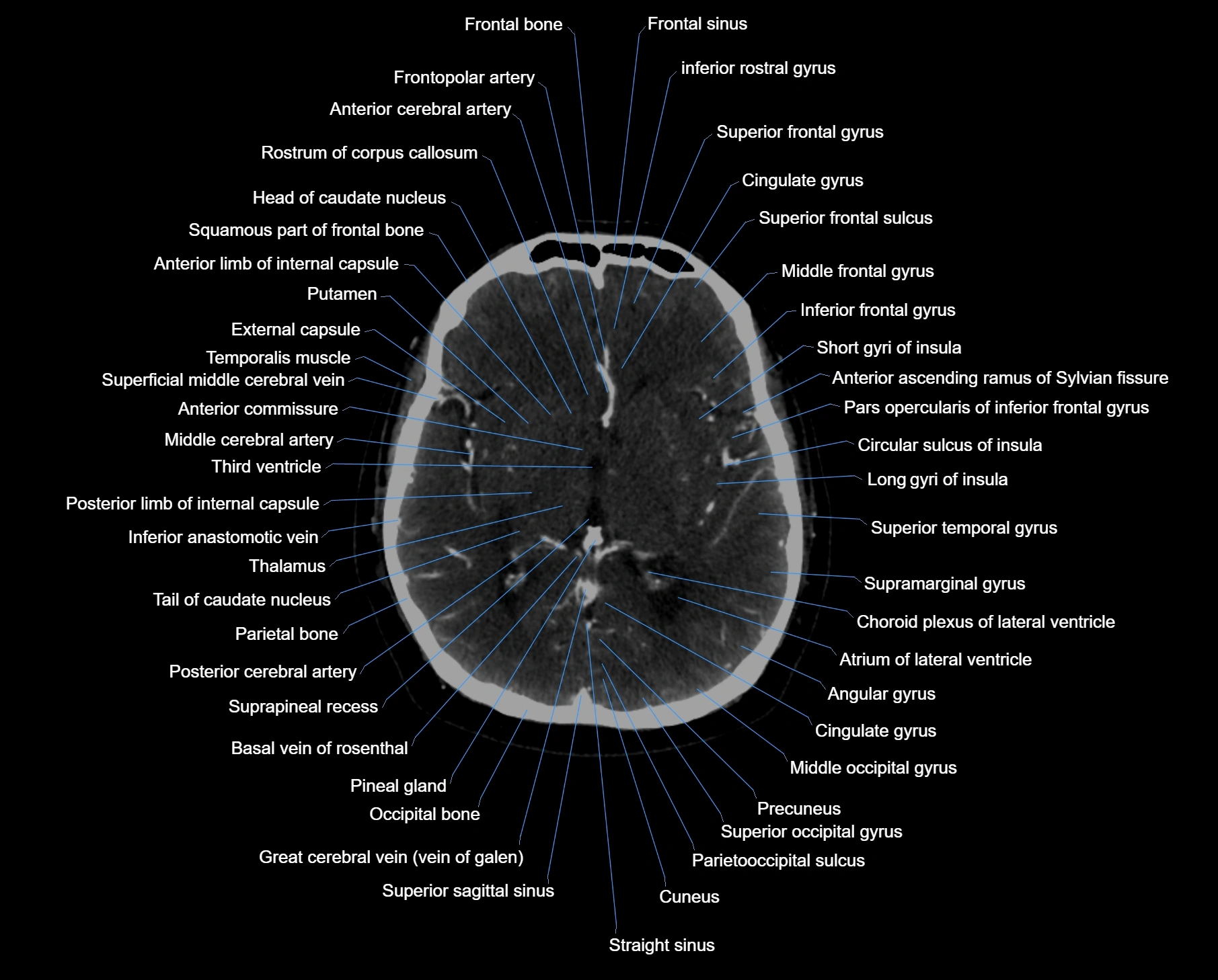 CT scan brain axial labelled cross sectional anatomy image-img-000035.webp